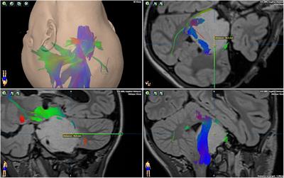 DNX-2401, an Oncolytic Virus, for the Treatment of Newly Diagnosed Diffuse Intrinsic Pontine Gliomas: A Case Report